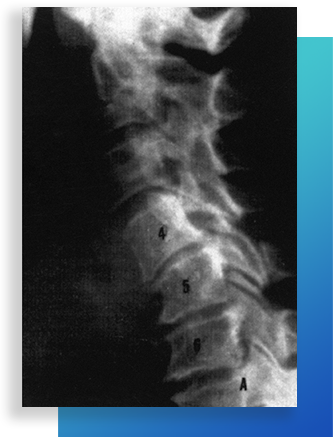 Polaris Chiropractic treatment Phase 3 Spinal Degeneration